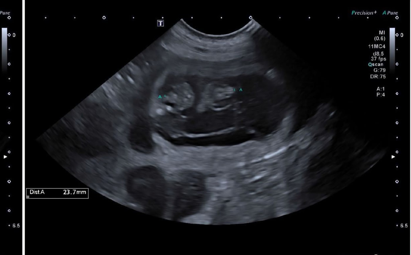 Bientot de nouveaux bébés